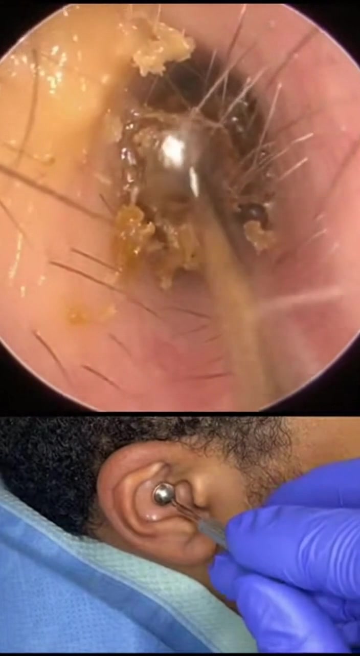 @Ear Cleaning