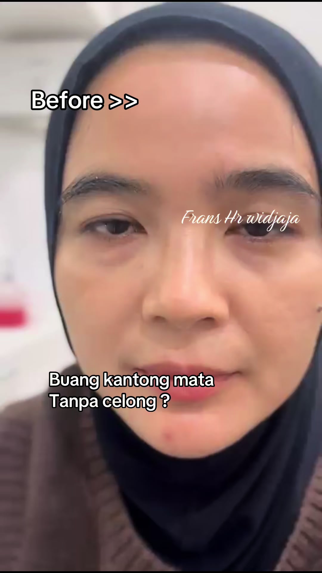 @FransHerywidjaja MD
