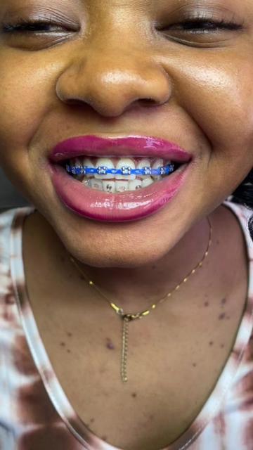 @Braces.bymavi|Smile Aesthetics