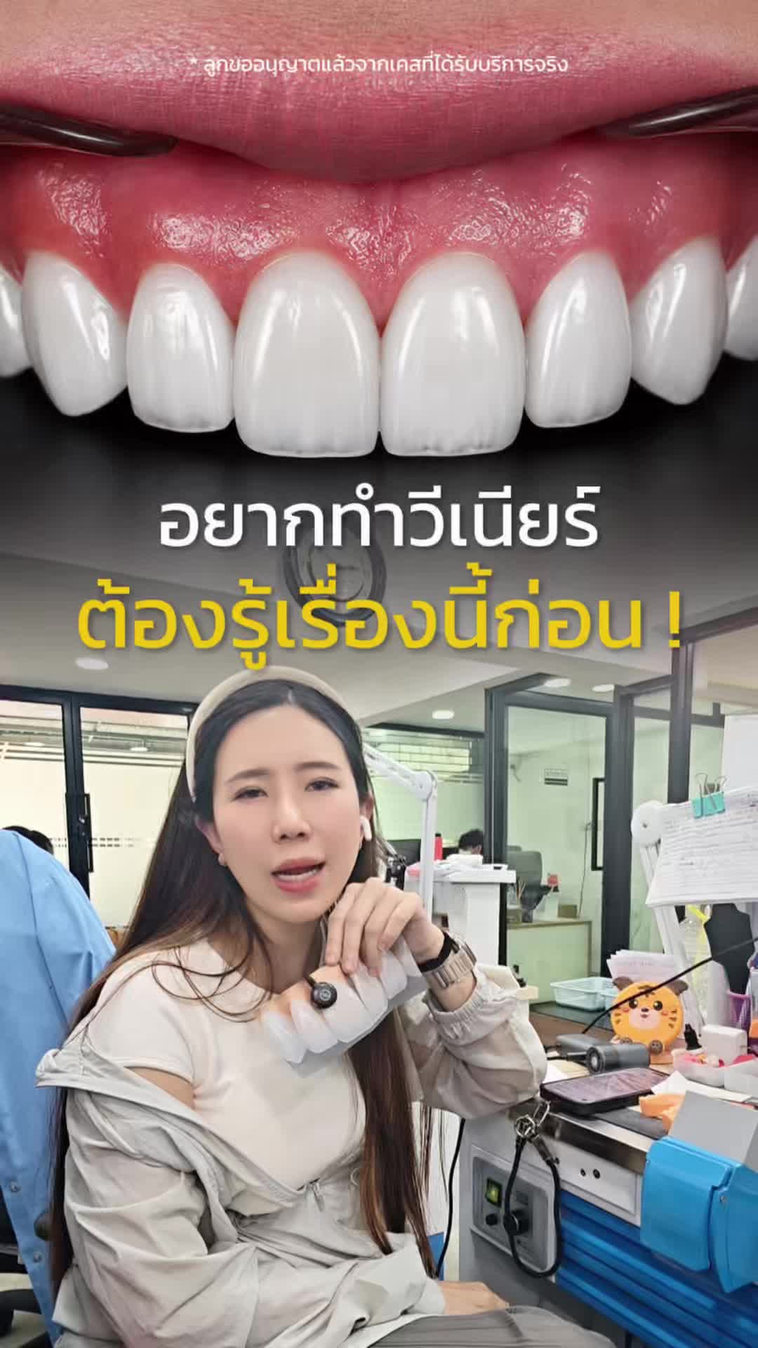 @หมอป่องสวยมาก veneer 🦷