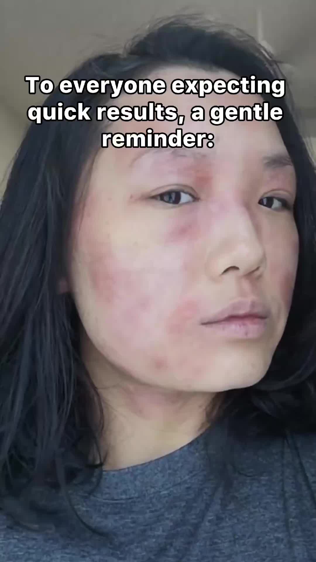 @Grace | TSW & Eczema Recovery