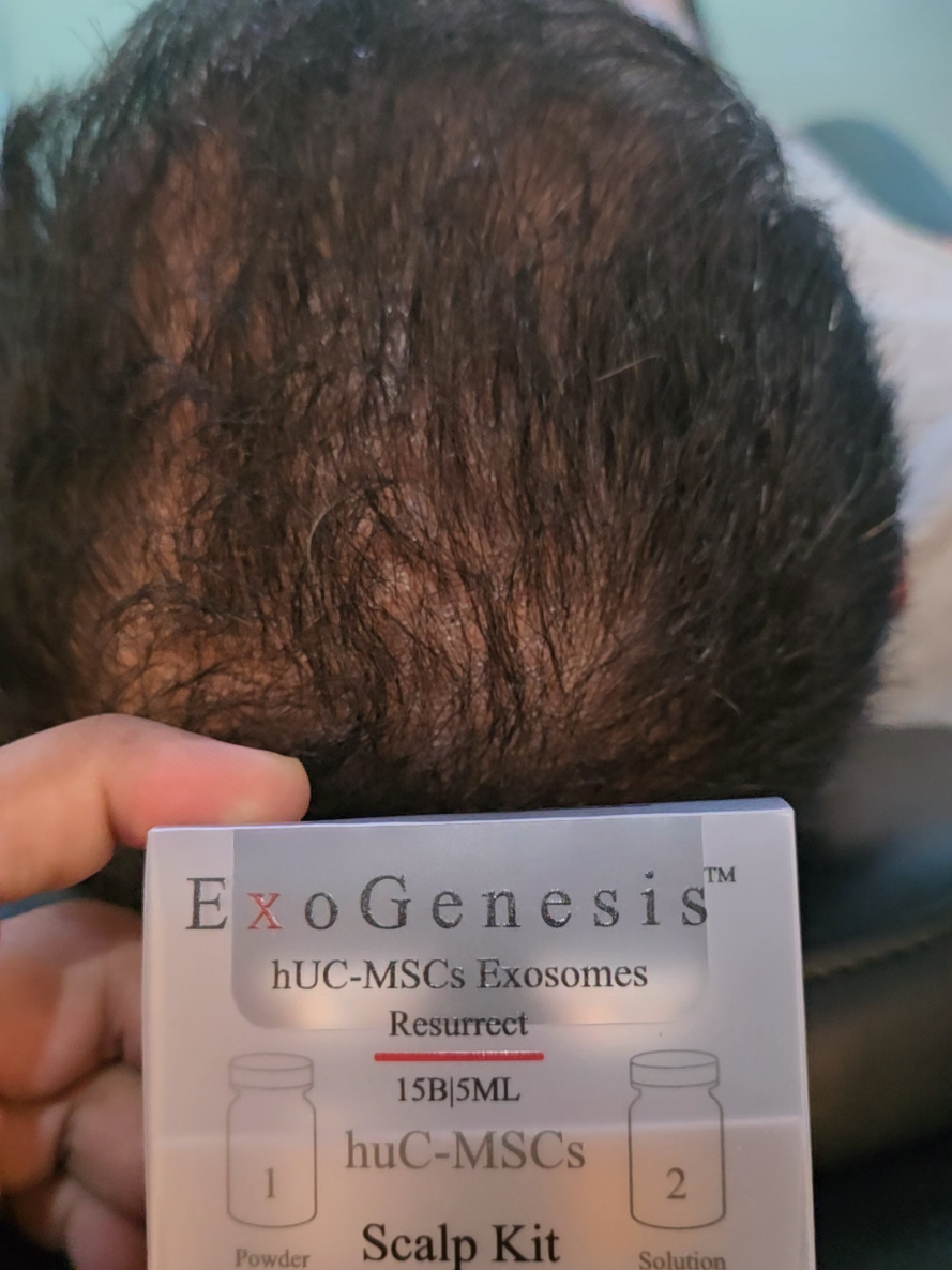@Dr Asad shalman HairTransplant