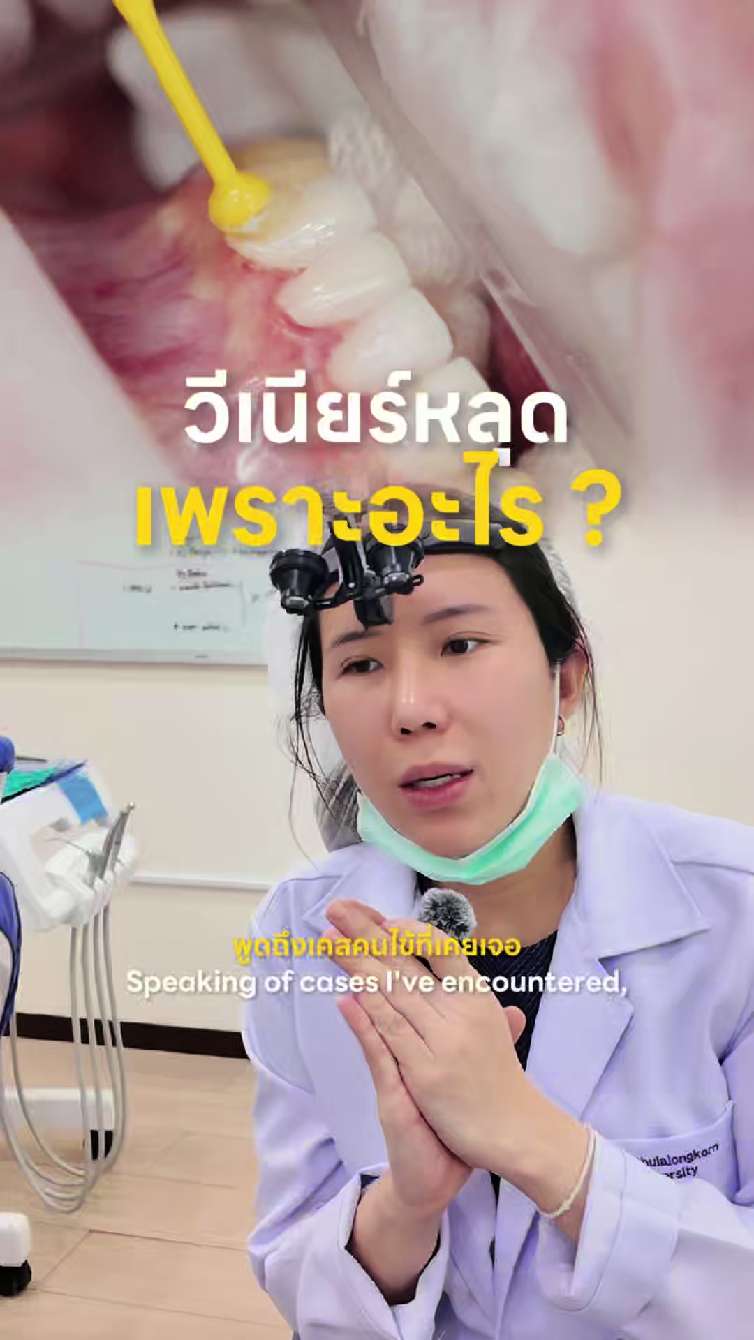 @หมอป่องสวยมาก veneer 🦷