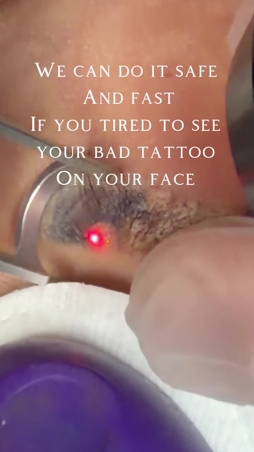 @Safe Eyebrows Tattoo Removal🗽