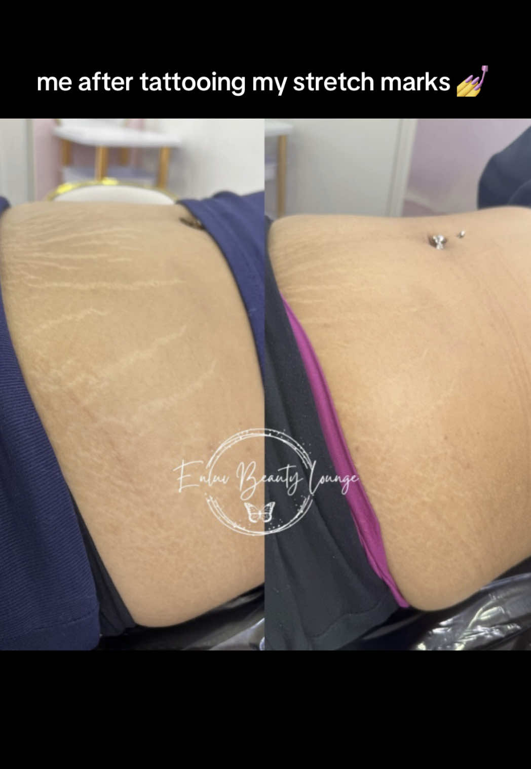 @Stretch Mark Fairy 🧚✨