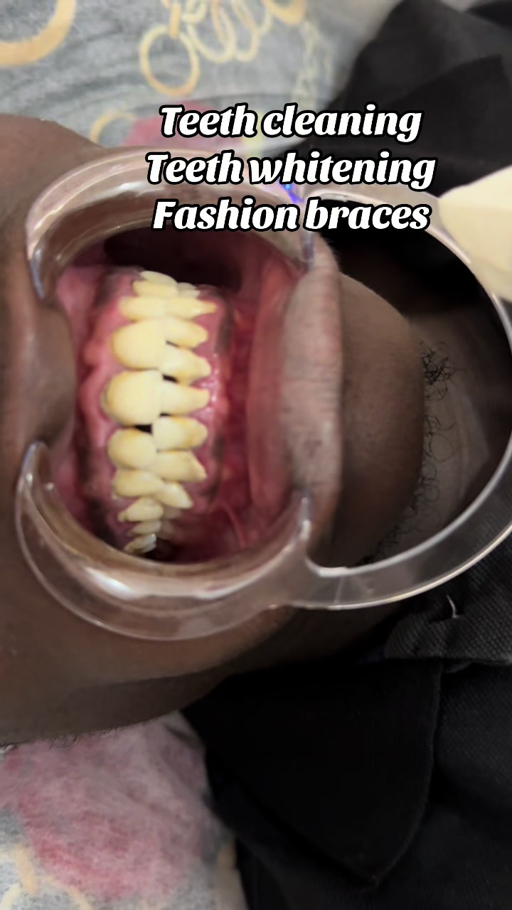 @Teethwhitening—MartGlow Avenue