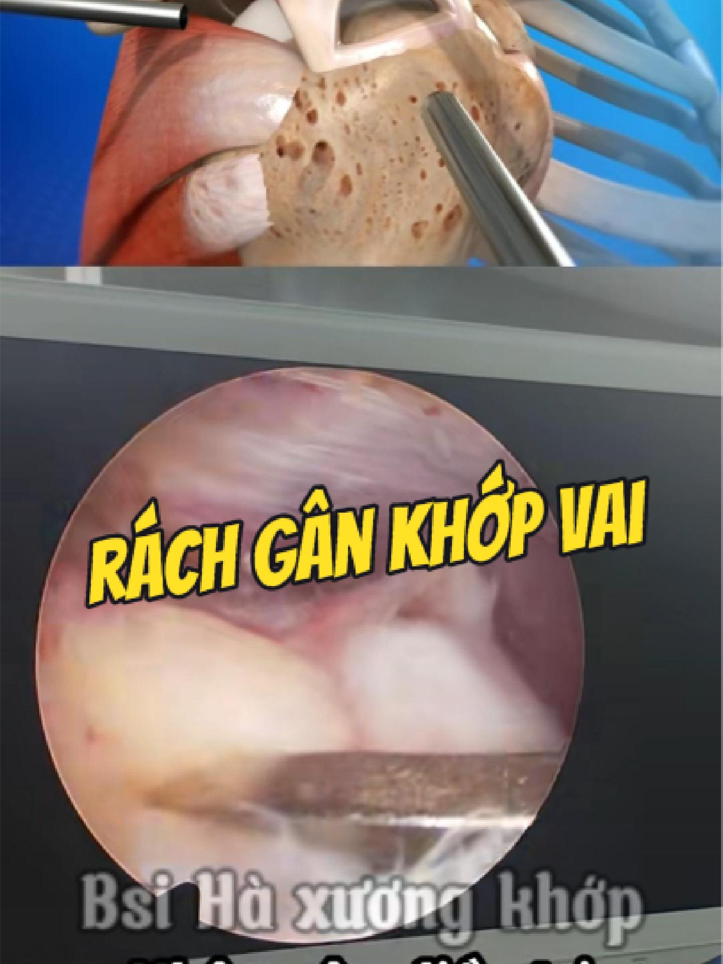 @Chuy&ecirc;n gia xương khớp
