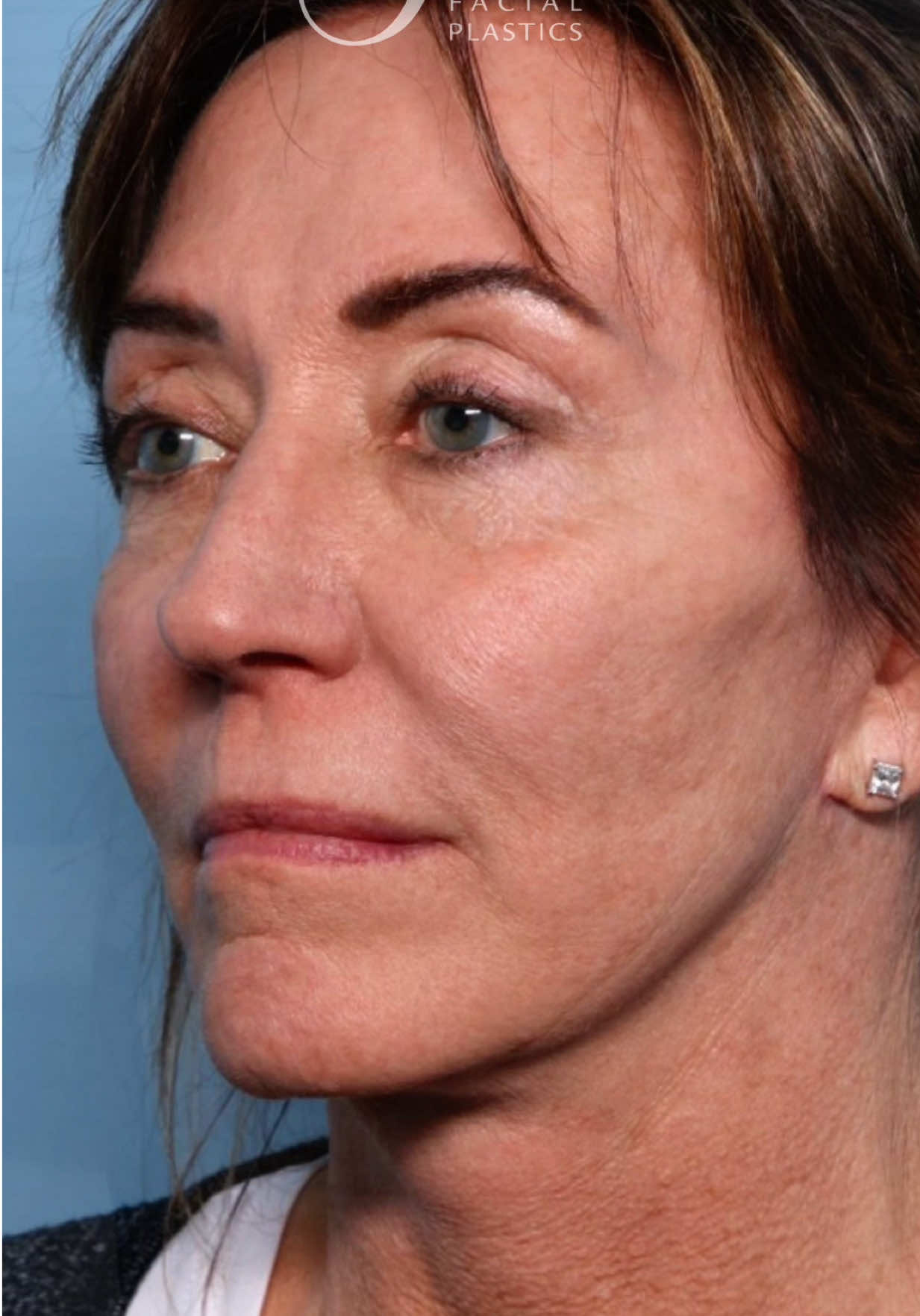 @Smith Facial Plastics