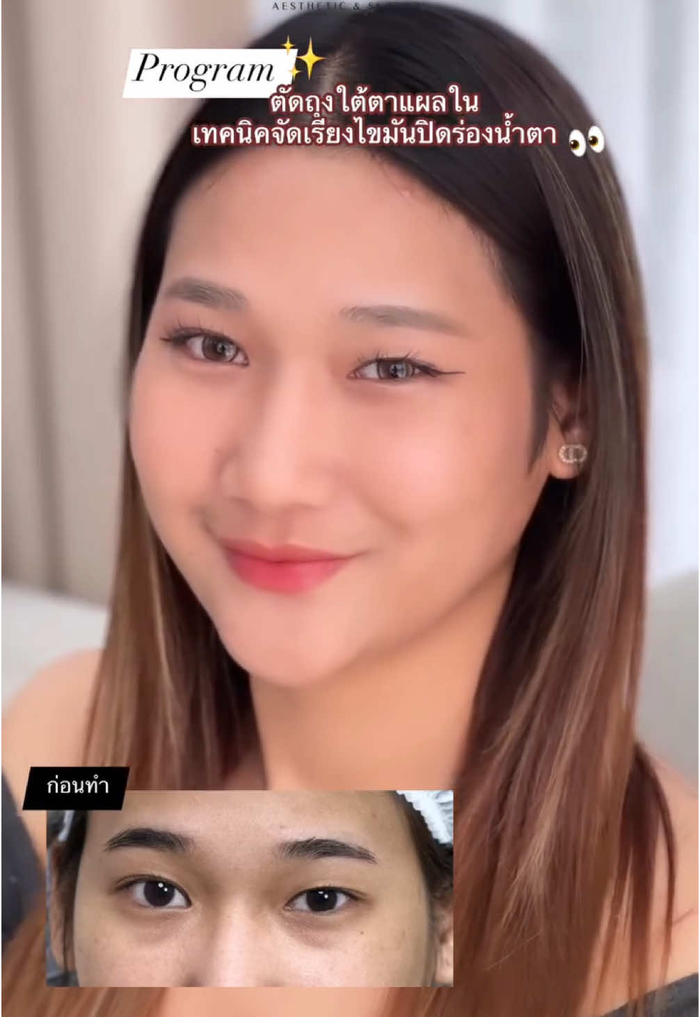 @เวลาคลินิก ตาสองชั้น ถุงใต้ตา