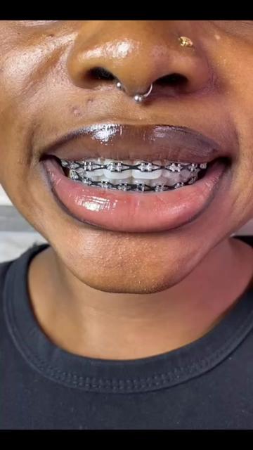 @Braces.bymavi|Smile Aesthetics