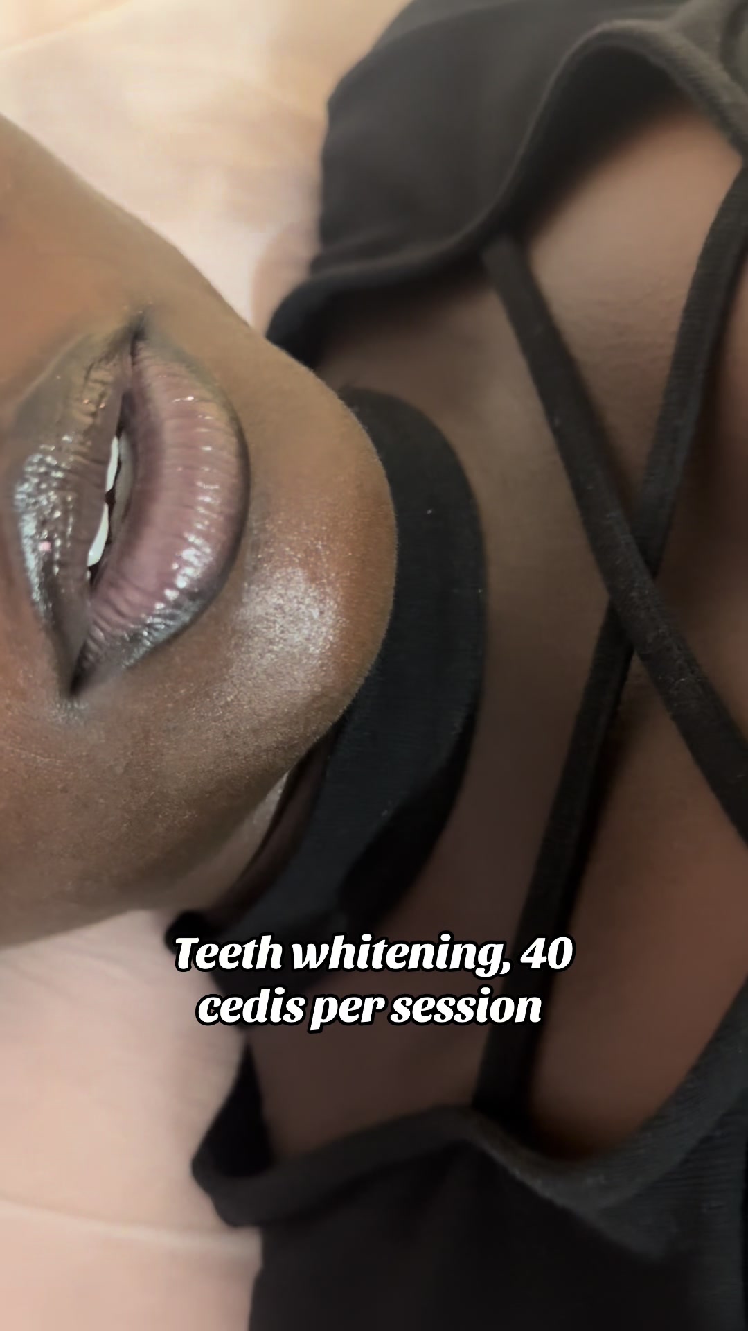 @Teethwhitening—MartGlow Avenue
