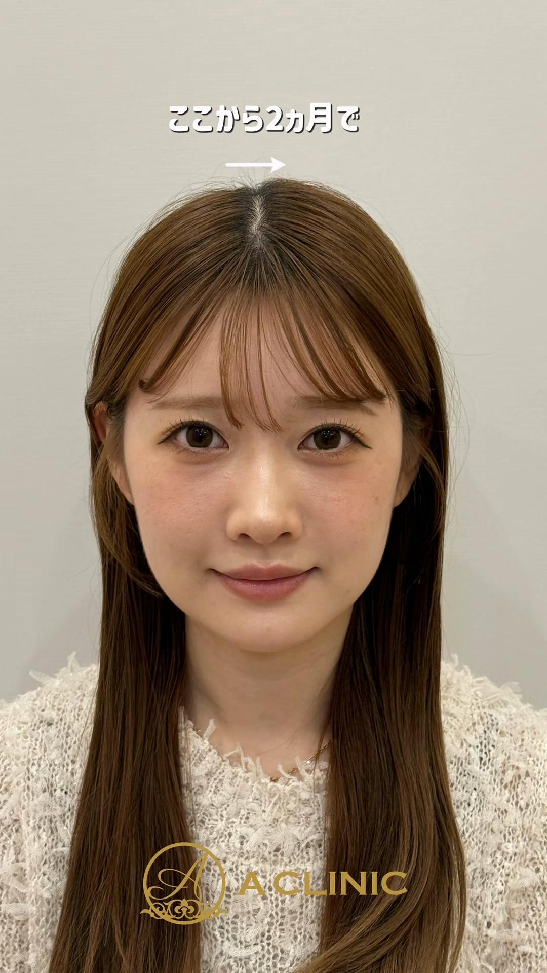 @ACLINIC池袋院【小顔/中顔面短縮】