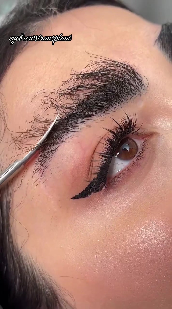 @Eyebrows Transplant