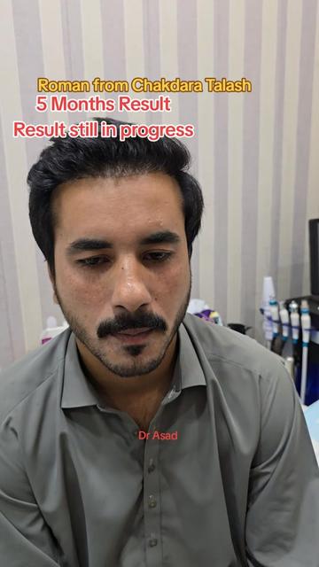 @Dr Asad shalman HairTransplant