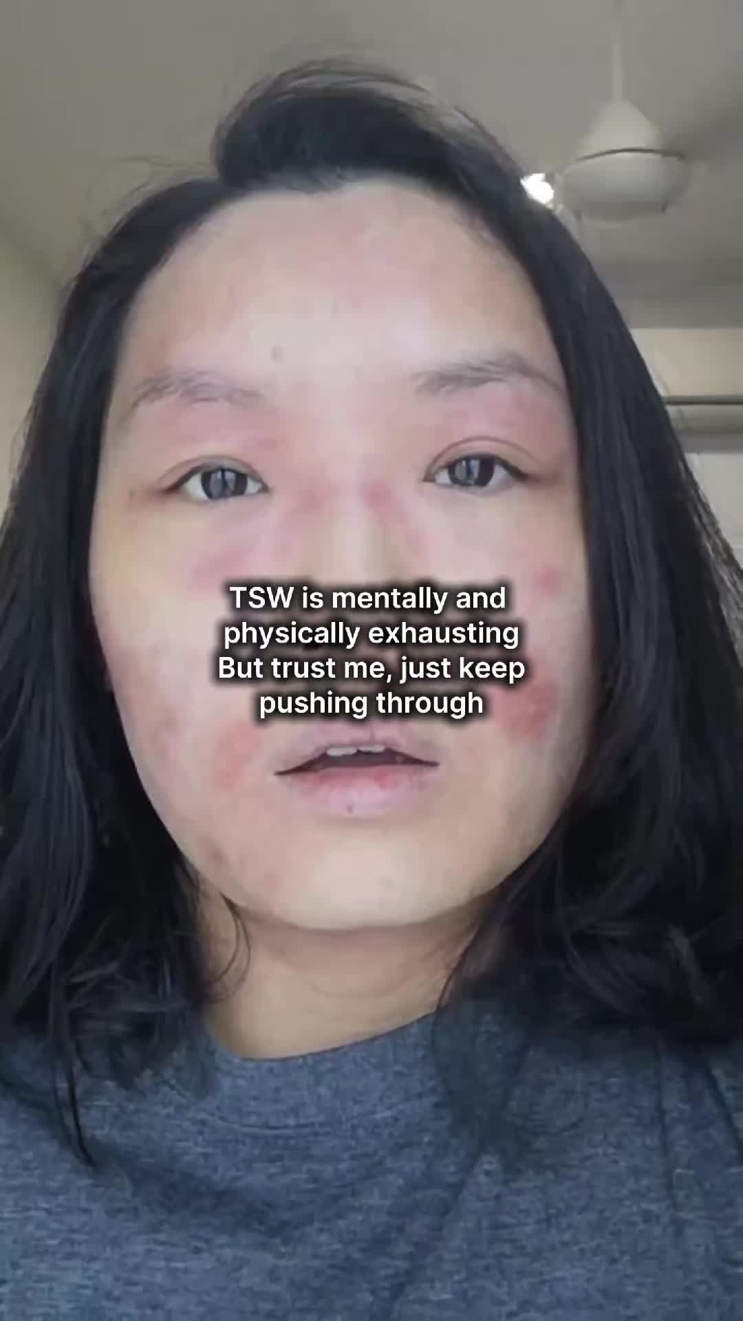 @Grace | TSW & Eczema Recovery