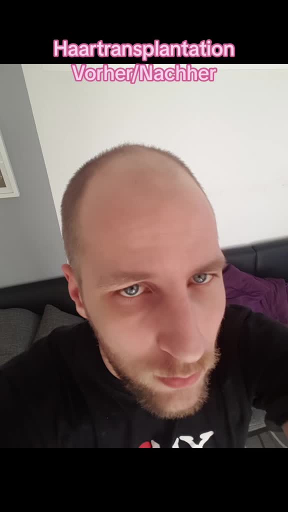 @Mr. Hairtransplant