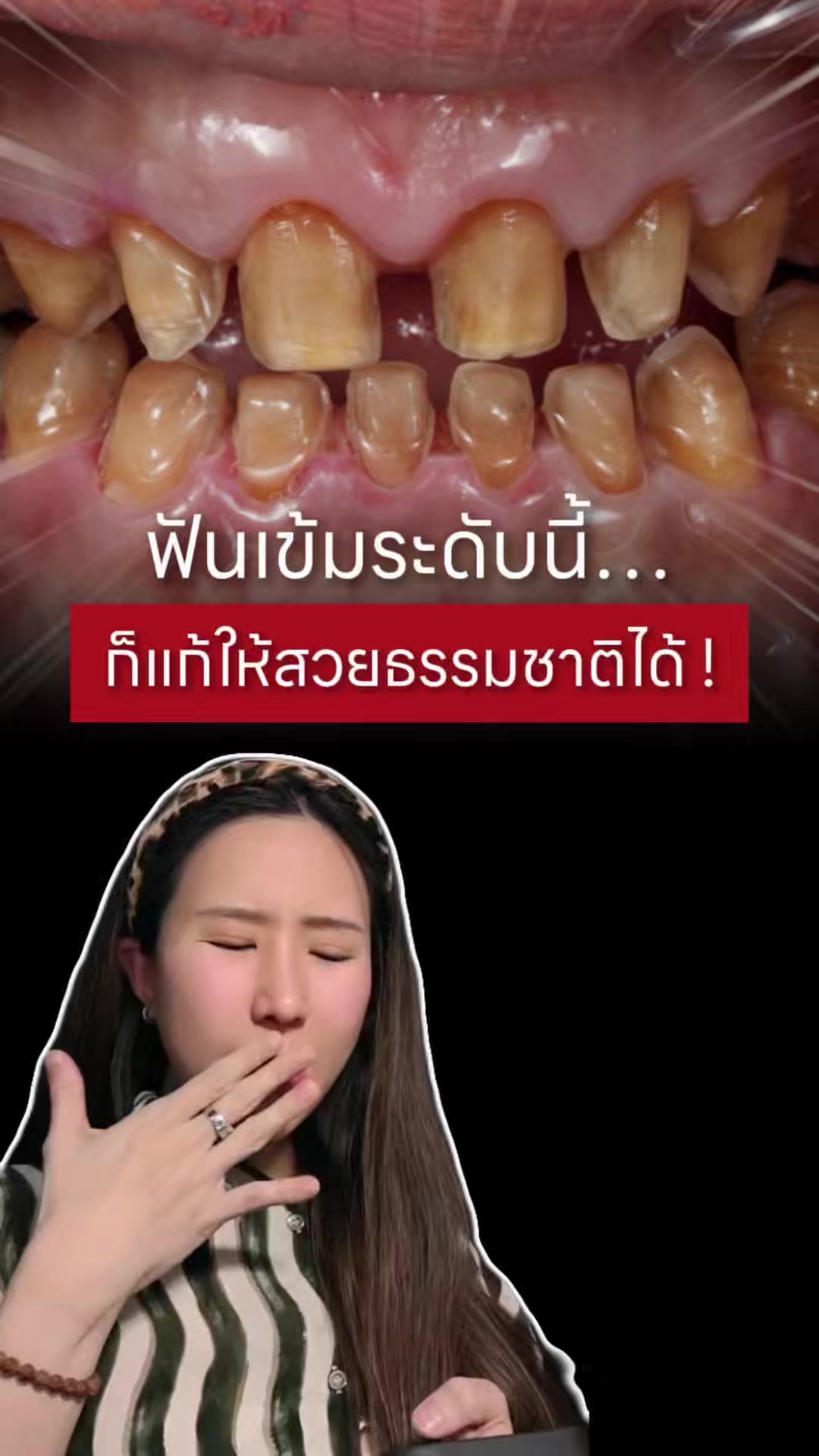 @หมอป่องสวยมาก veneer 🦷