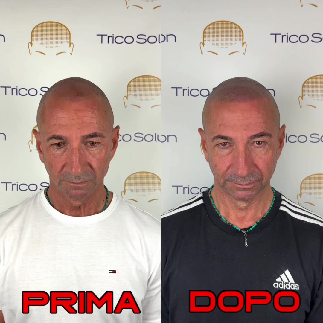 @TricoSolution di Davide Tini