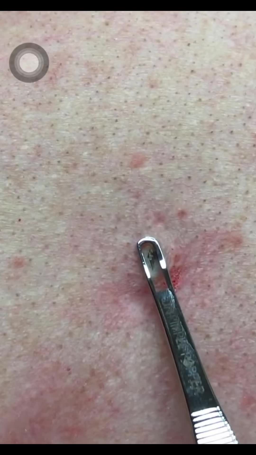 @pimplepopperasmr