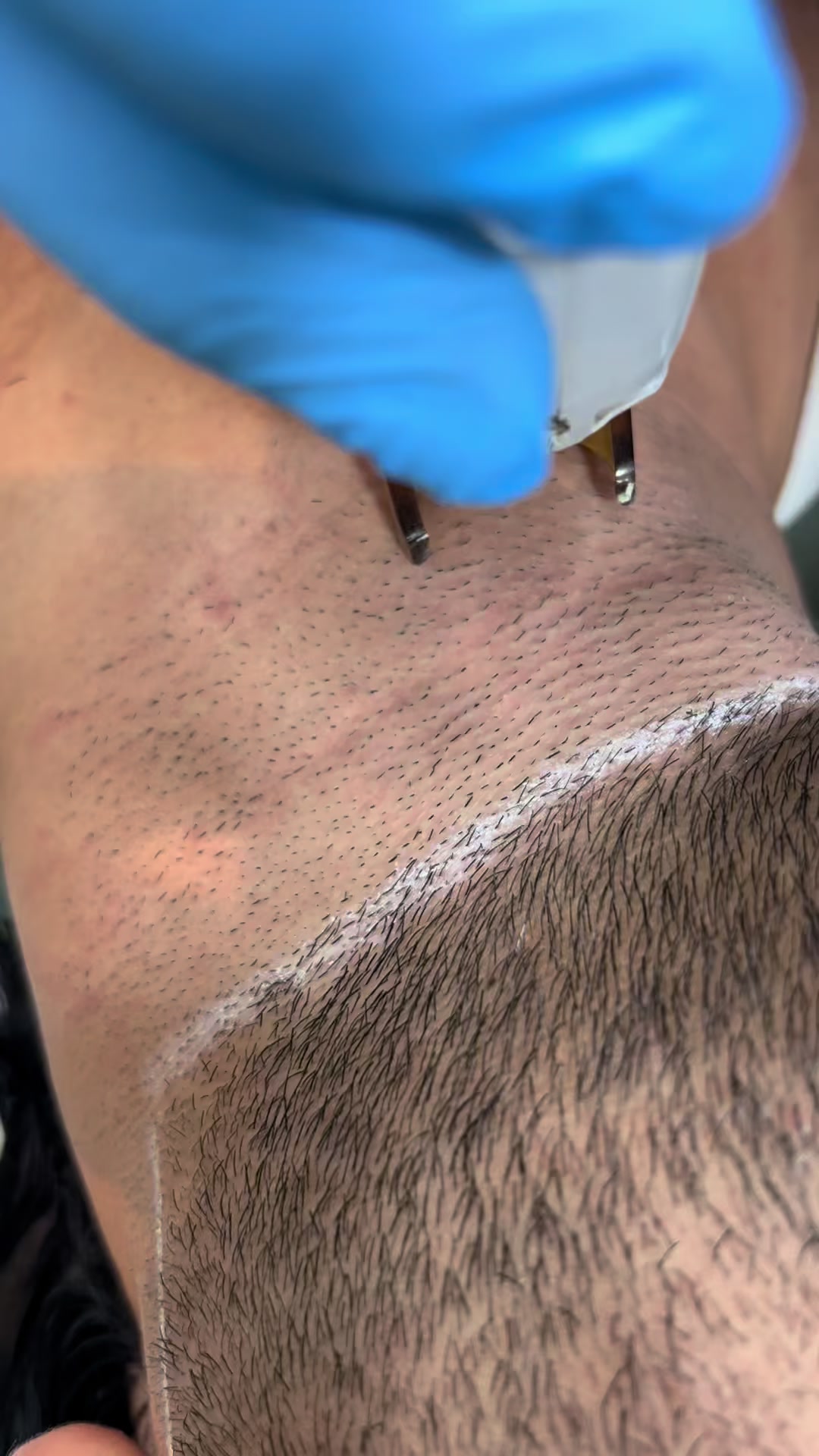 @Laser Grafix clinic