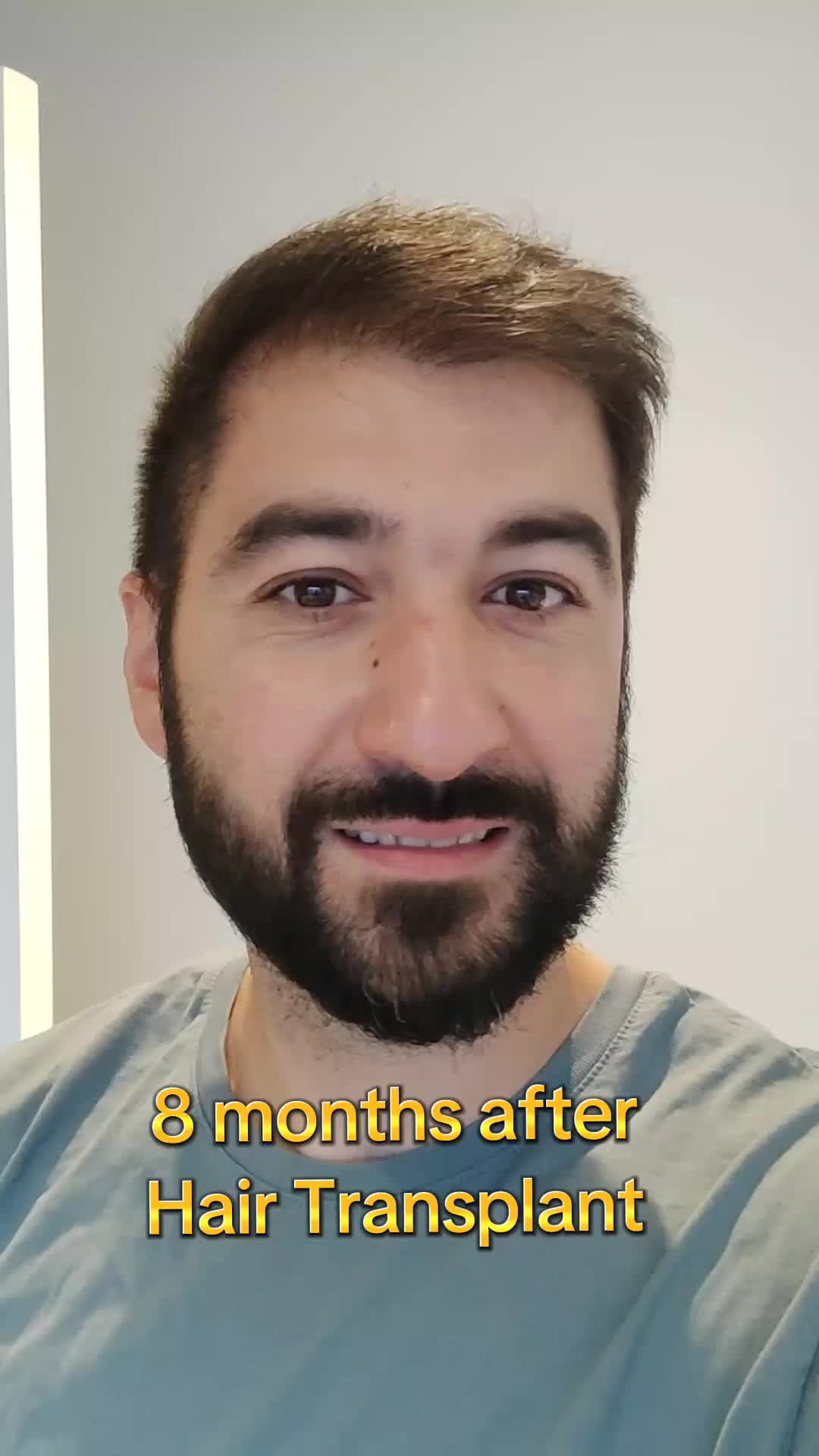 @My hair transplant