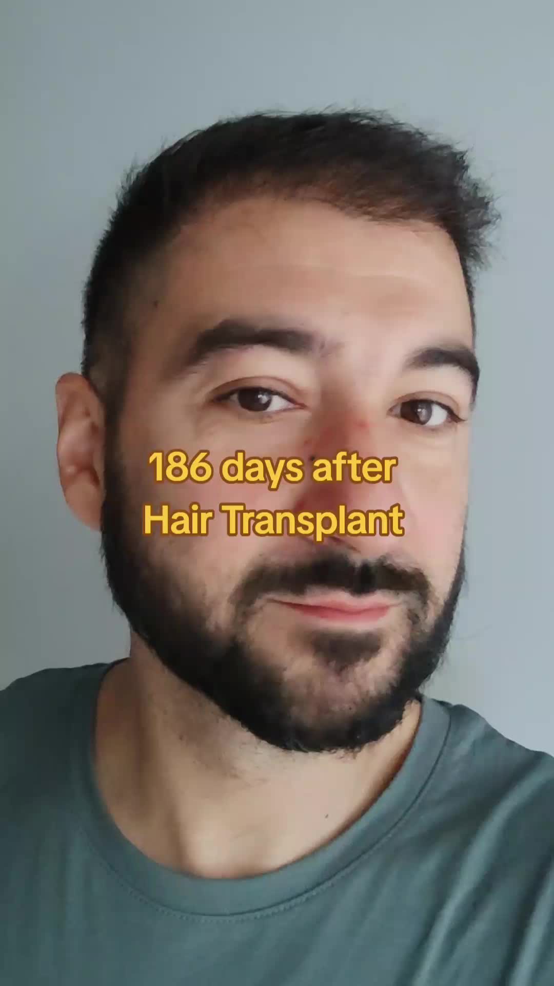 @My hair transplant