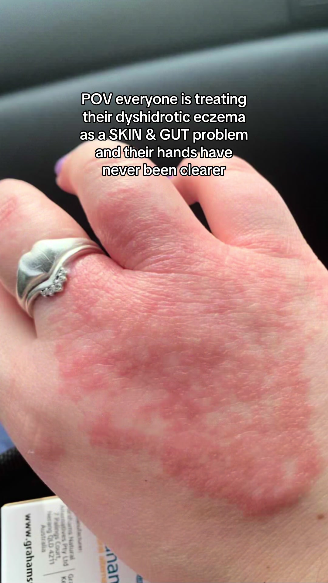 @Eczema Diaries USA & UK