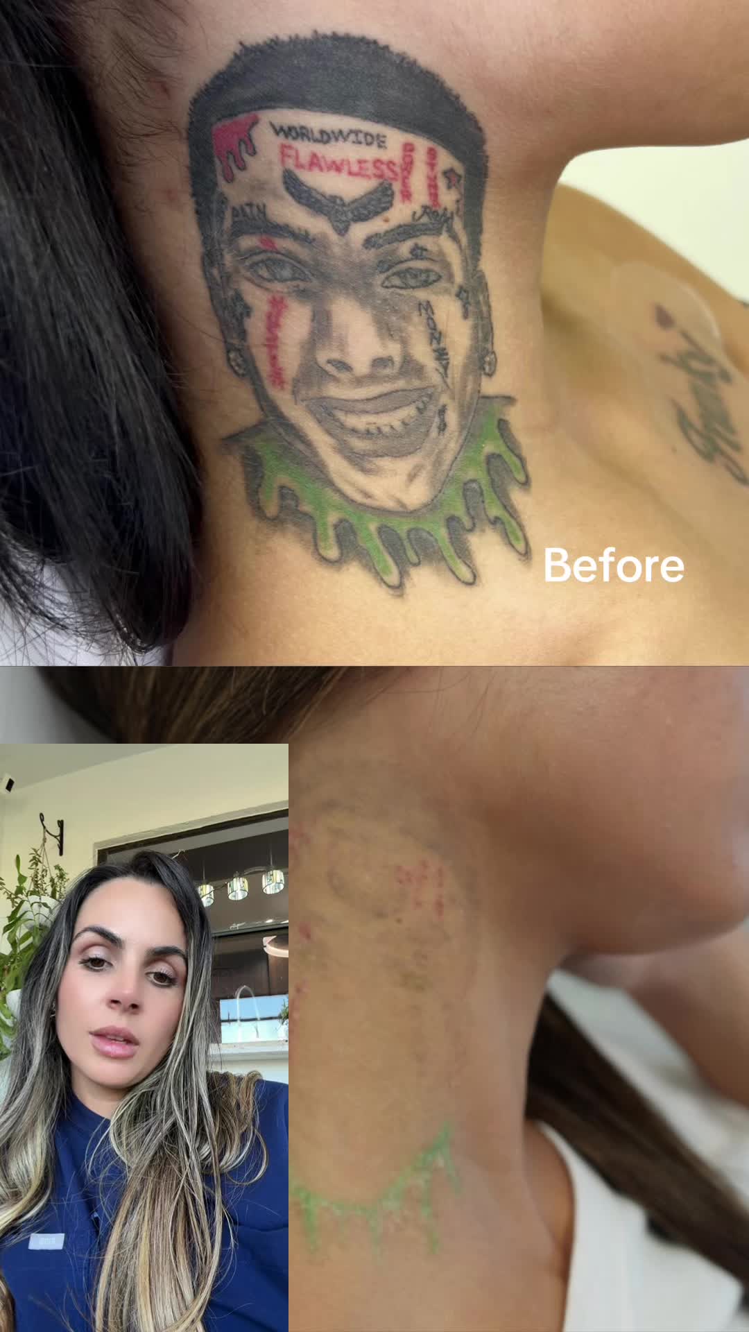 @@BHLASERTATTOOREMOVAL
