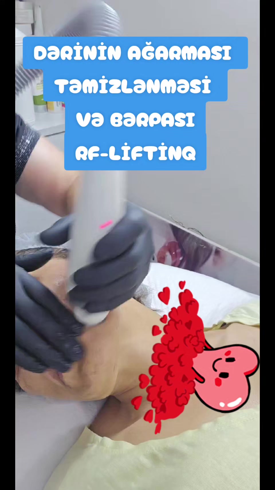 @ehmedli_kosmetoloq_lazeroloq