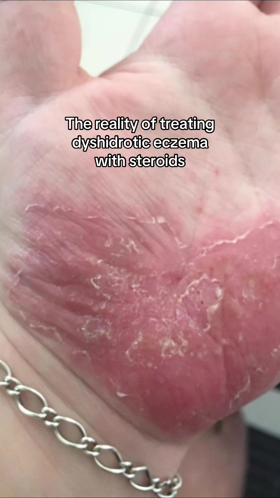 @Eczema Diaries USA & UK