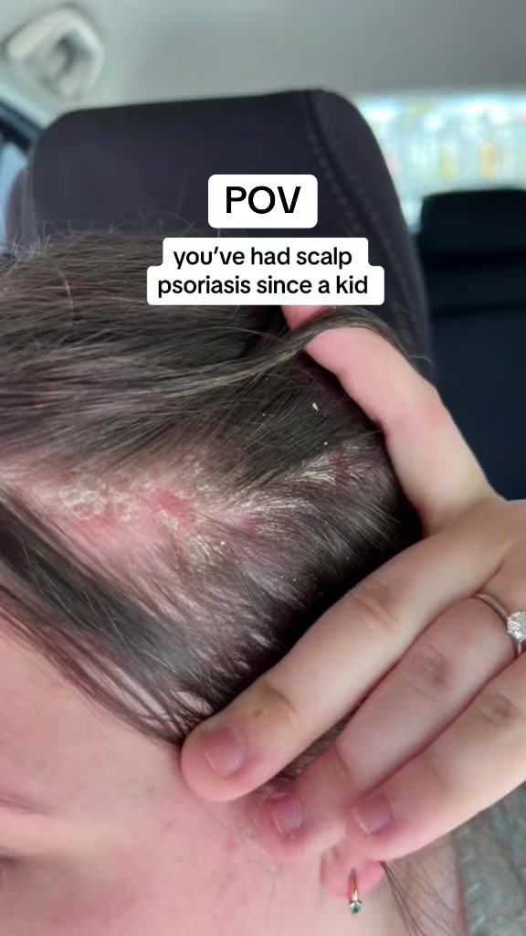 @Eczema Diaries USA & UK