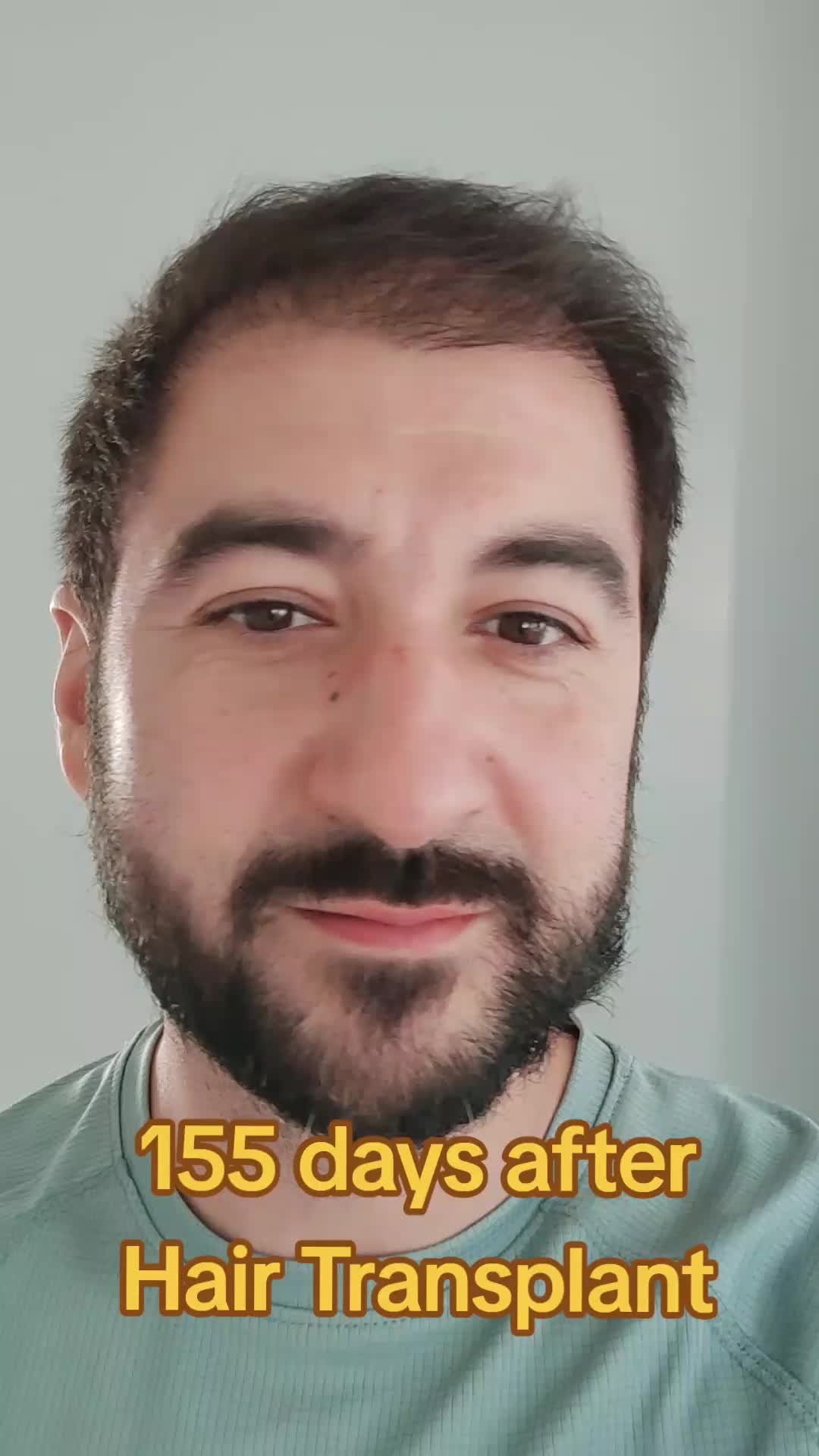 @My hair transplant
