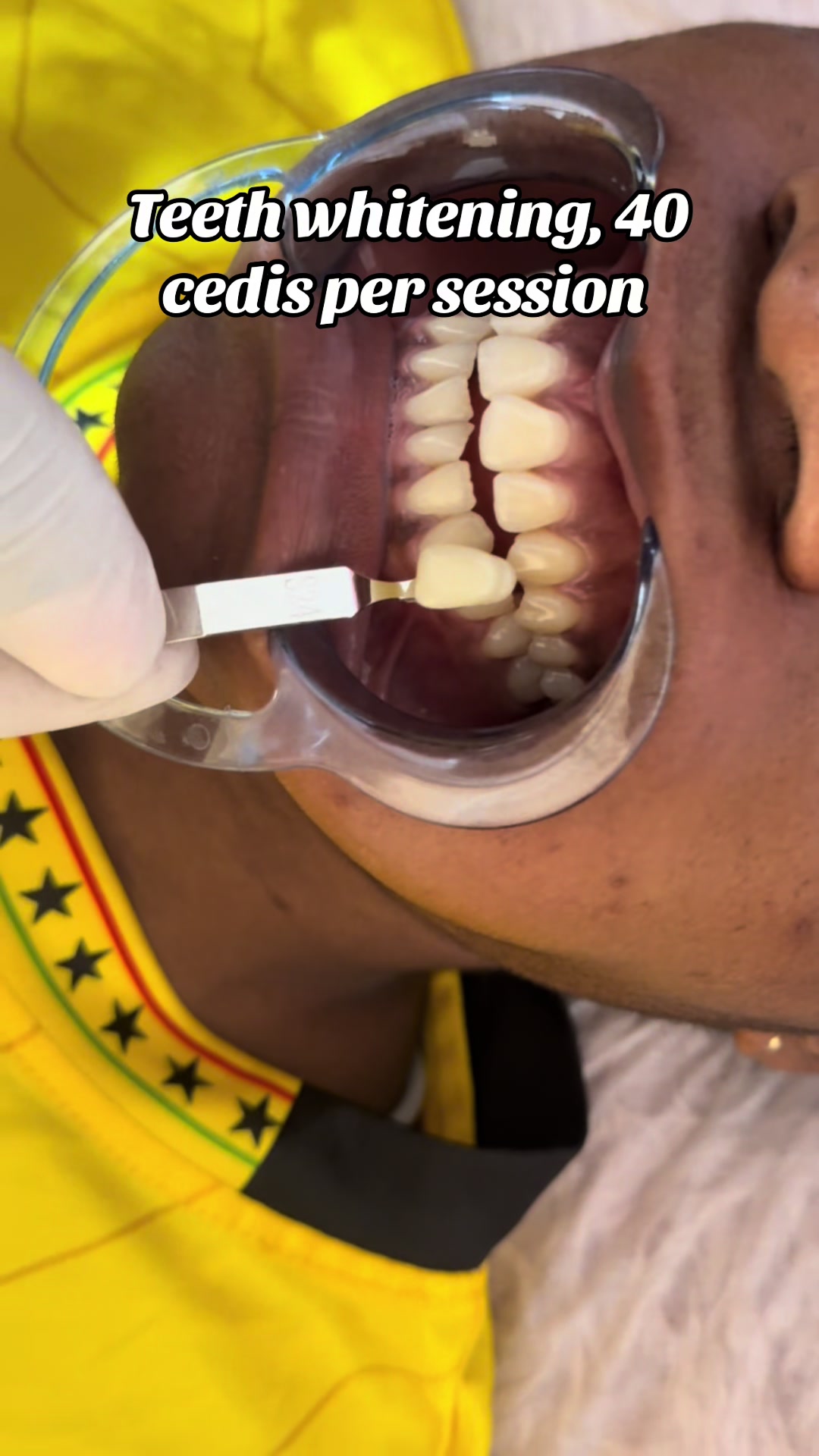 @Teethwhitening—MartGlow Avenue