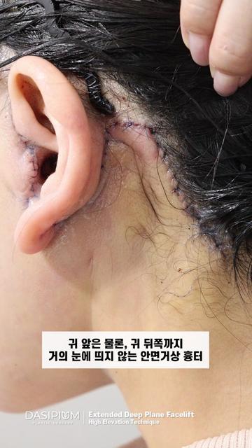 @다시피움성형외과 DASIPIUM タシピウム