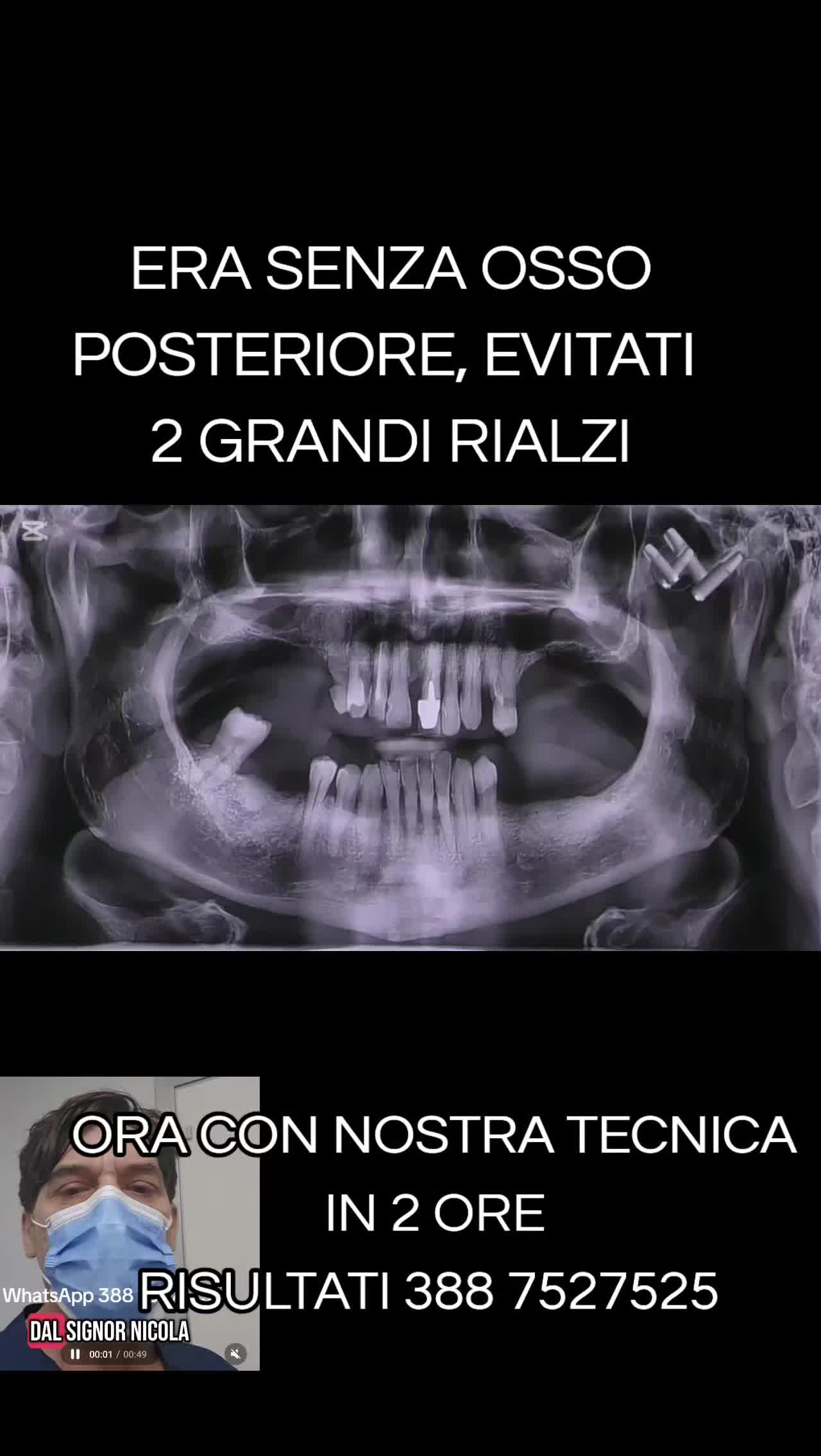 @Implantologiaprezzi