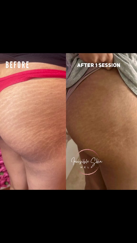 @Invisibleskinhelp