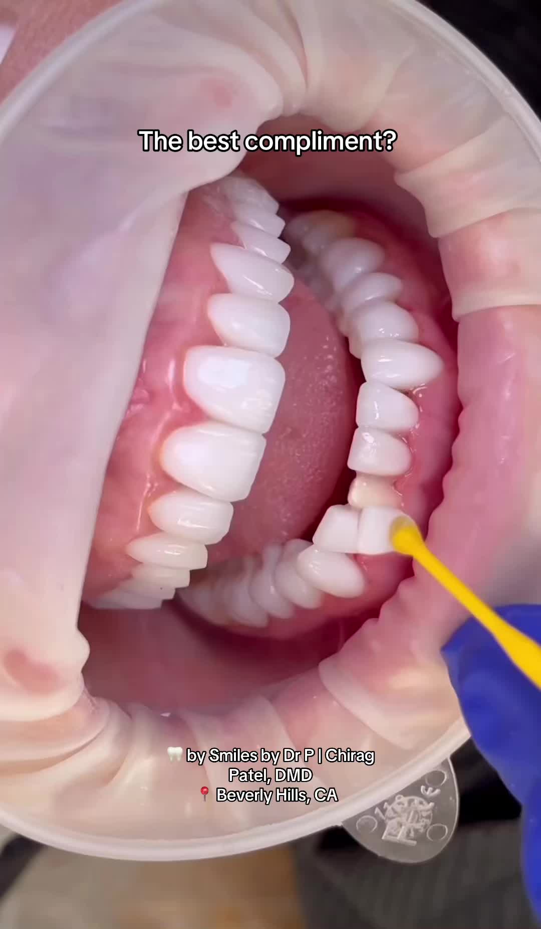 @Veneers