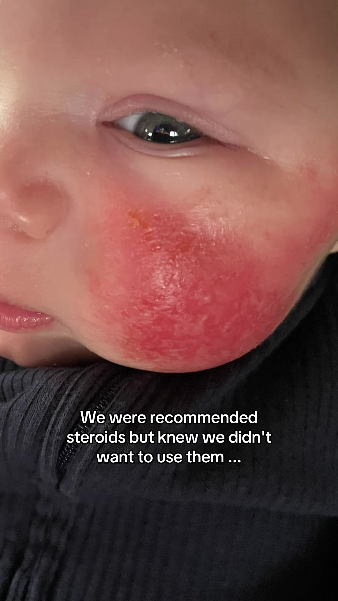 @Eczema Diaries USA & UK