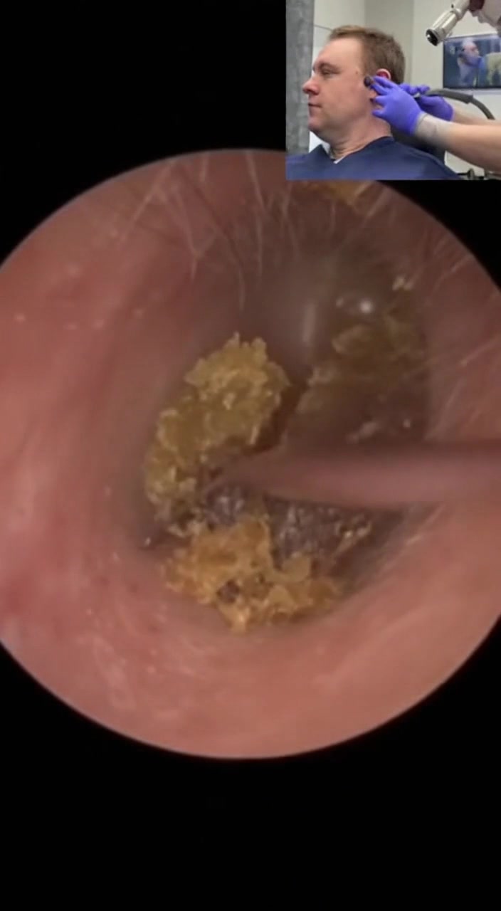 @Ear Cleaning