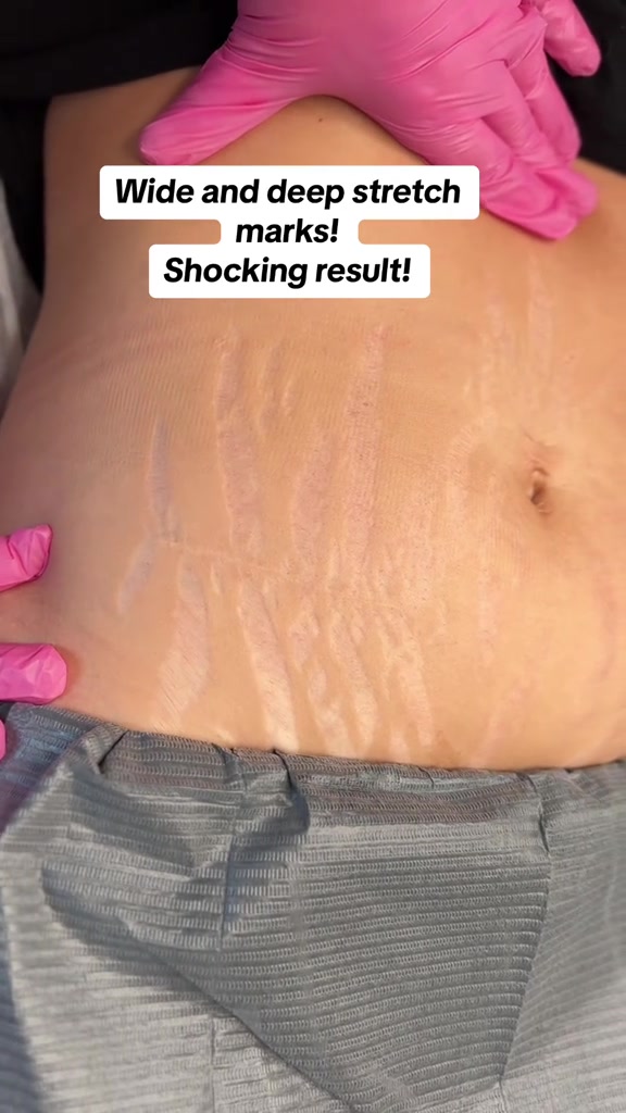 @Invisibleskinhelp