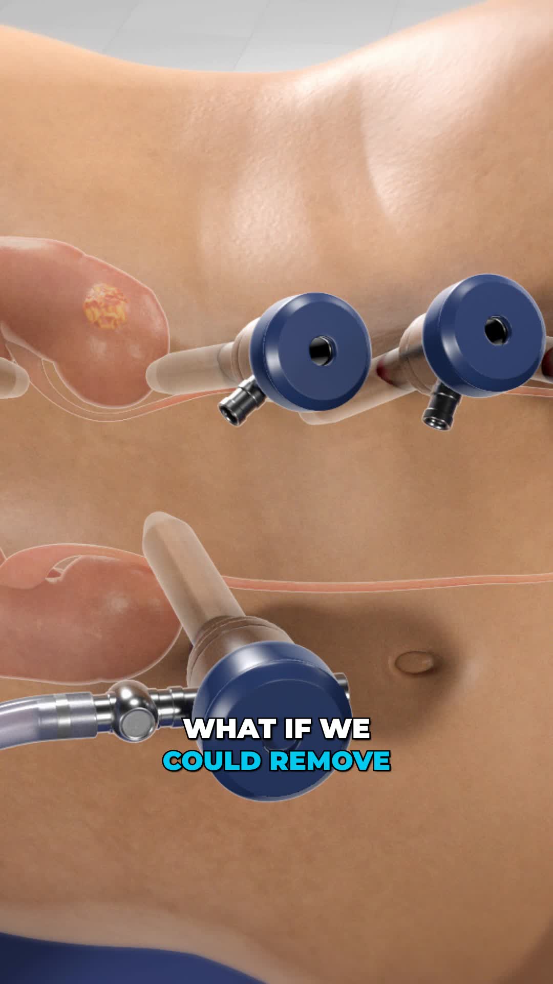 @Viz Medical