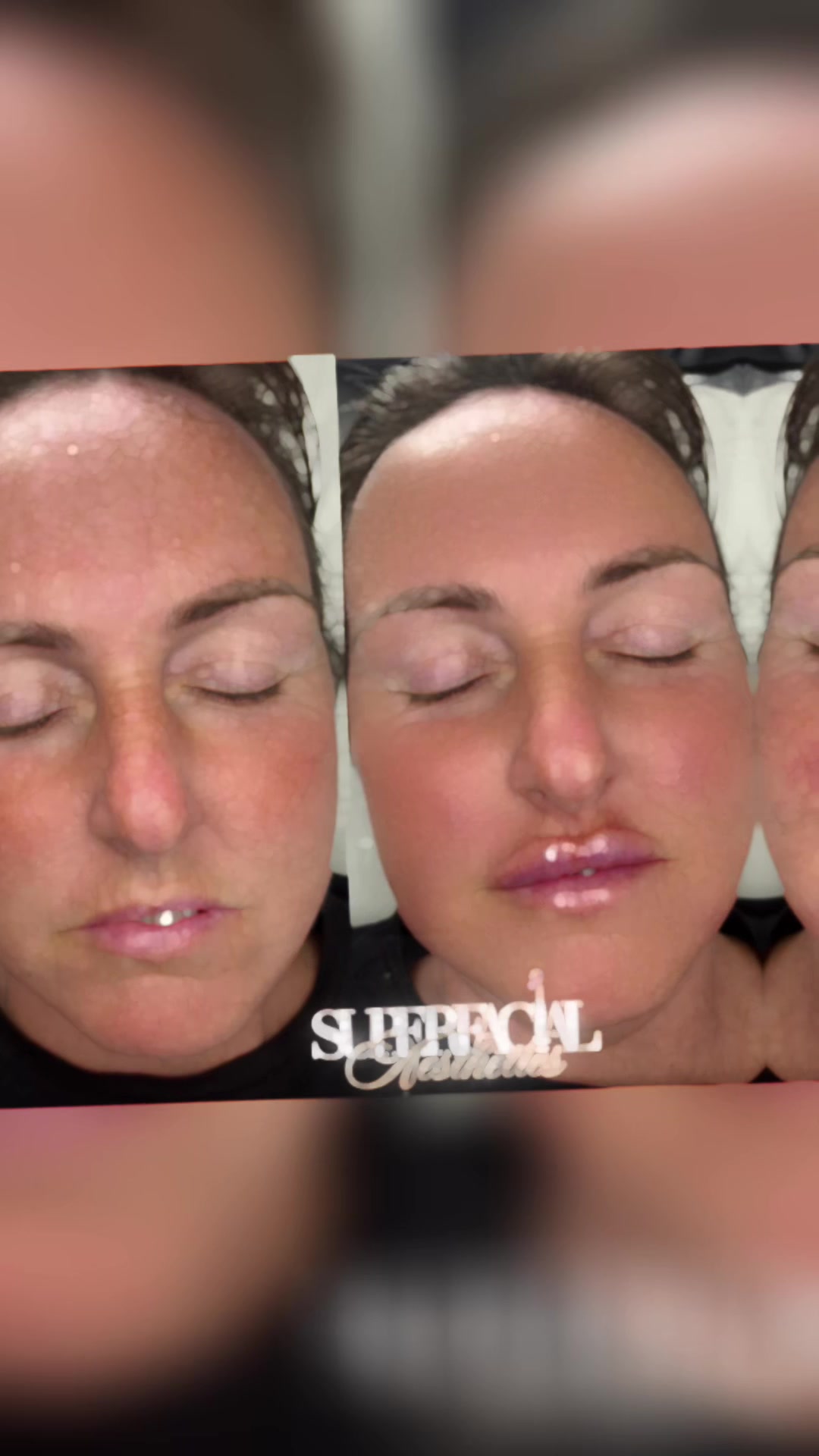 @Superfacial Aesthetics