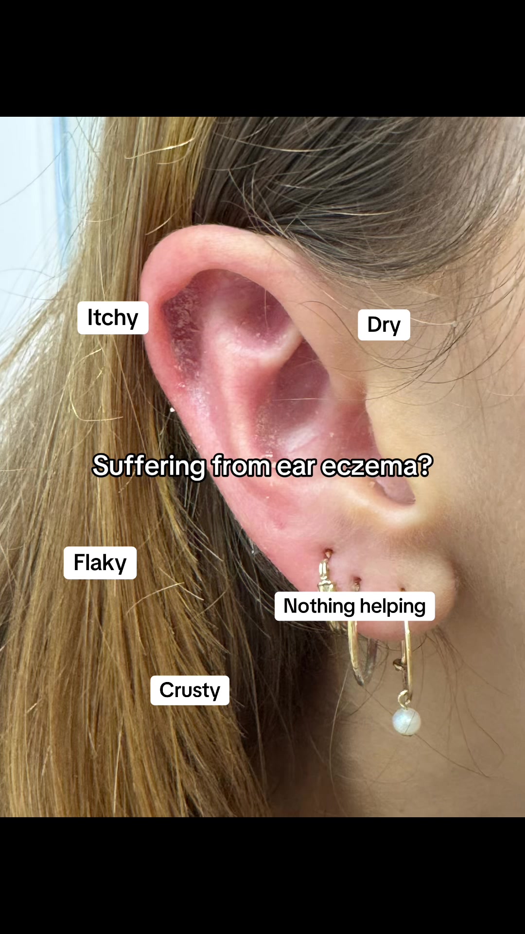 @Eczema Diaries USA & UK