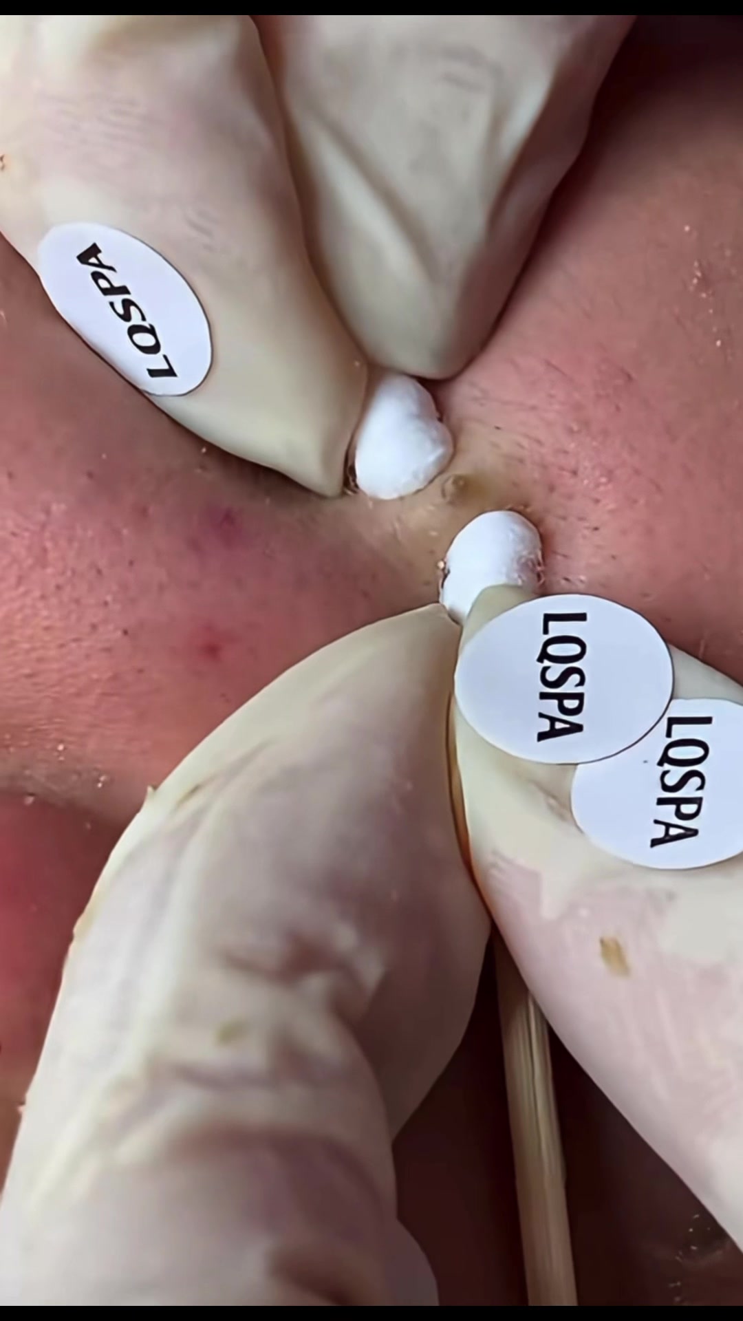 @pimplepopperasmr