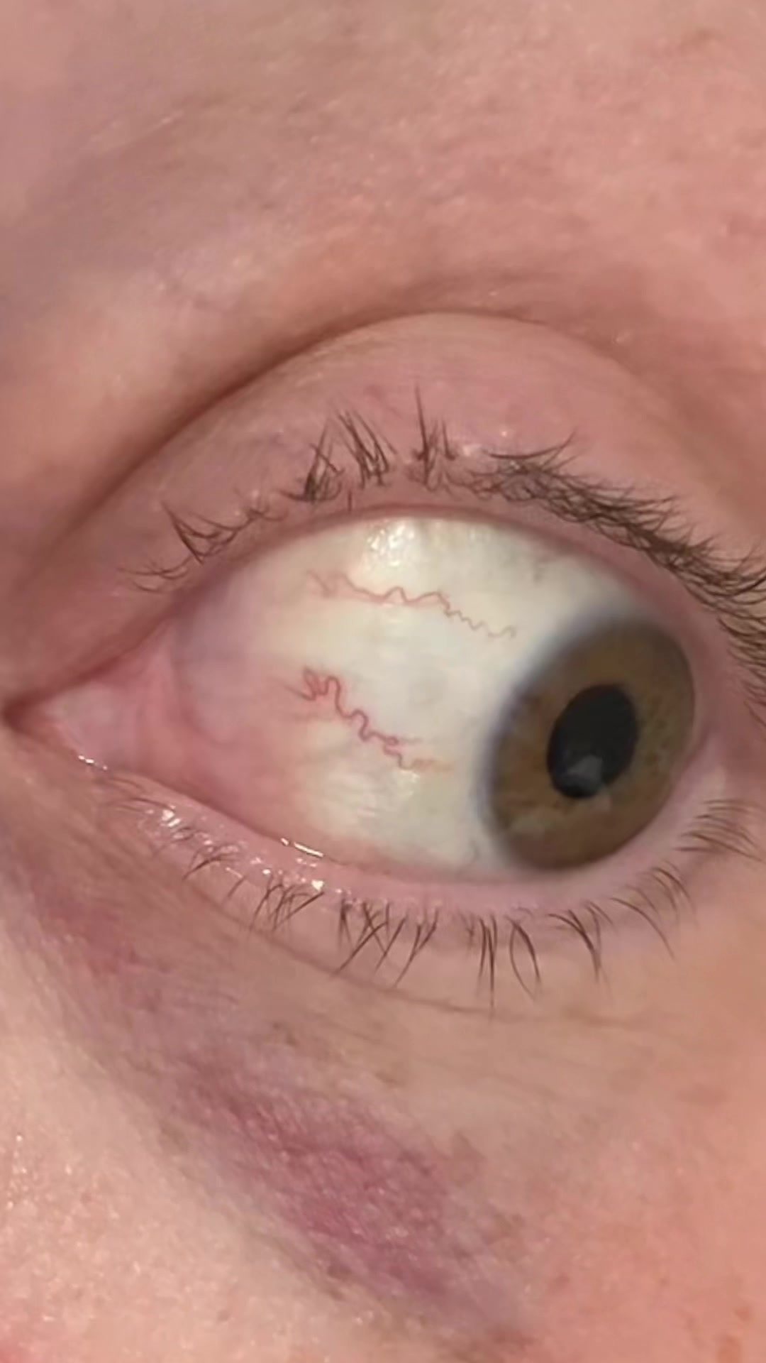 @eyeofthesarcoma