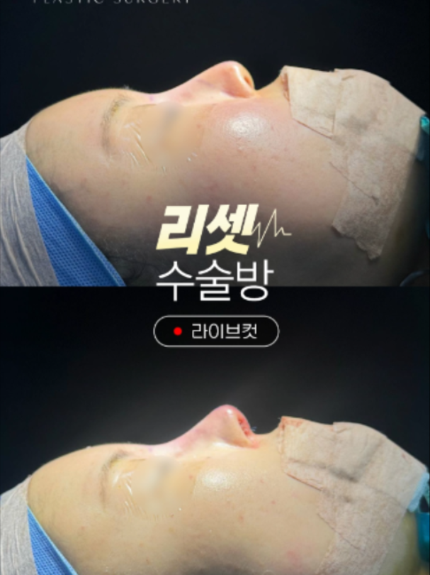 @리셋성형외과