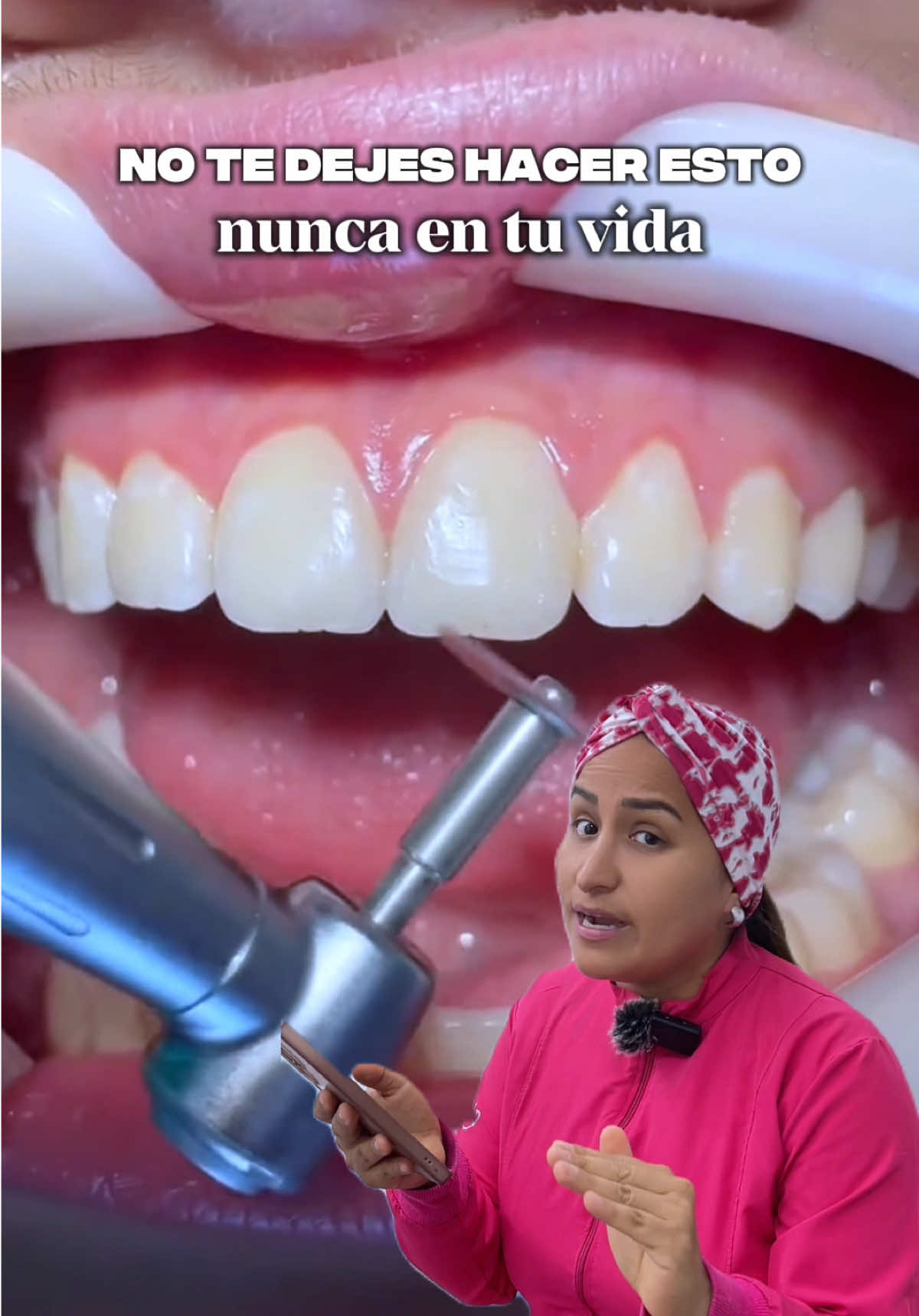 @Brackets y Alineadores