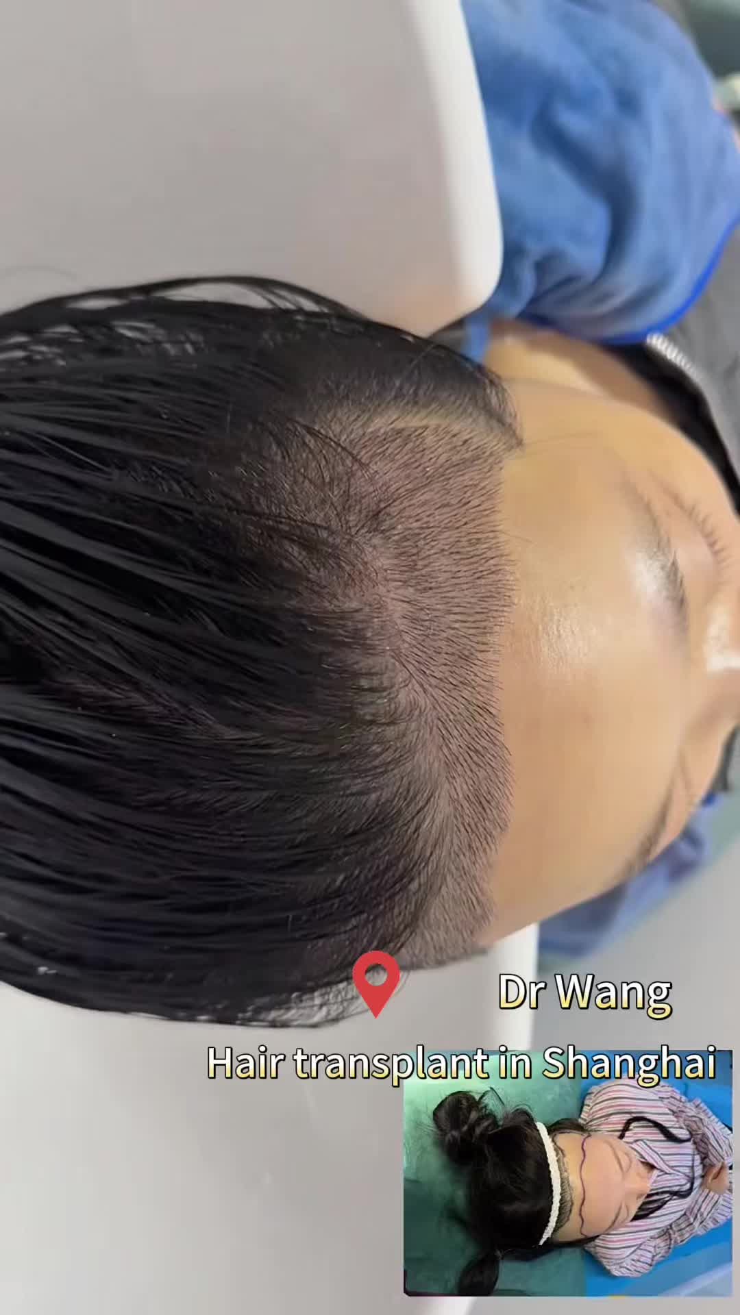 @HAIR TRANSPLANT WANG🇨🇳