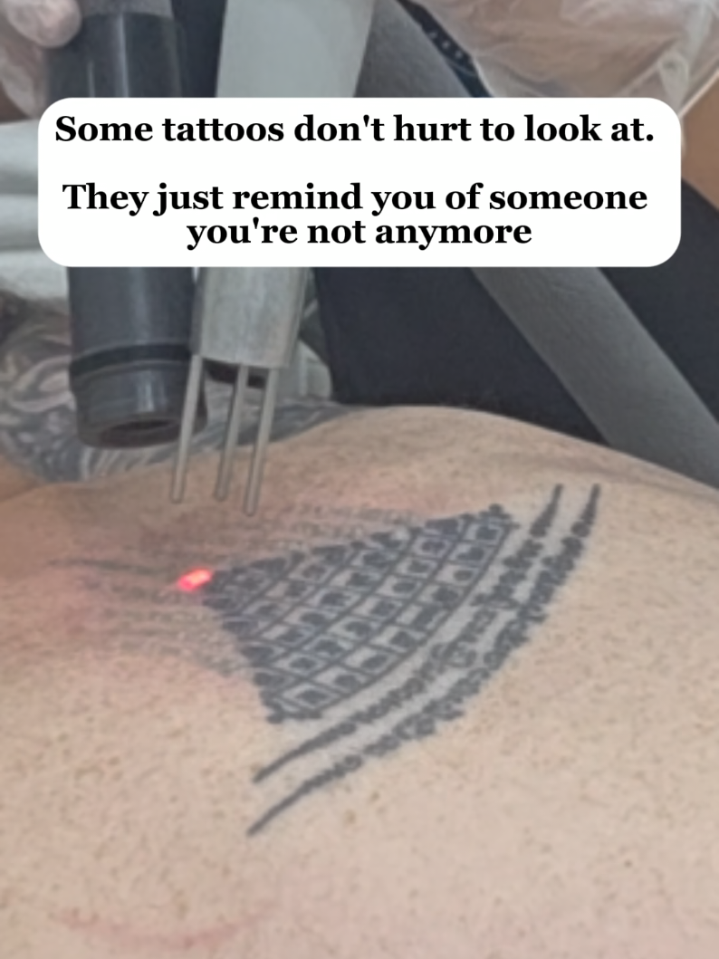 @Jamie T| Tattoo Removal Expert