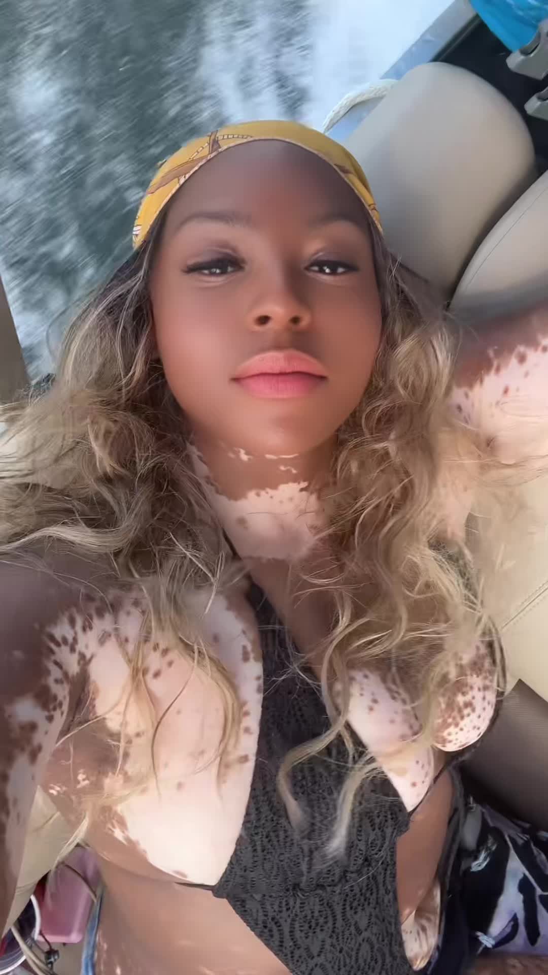 @VitiligoFairy